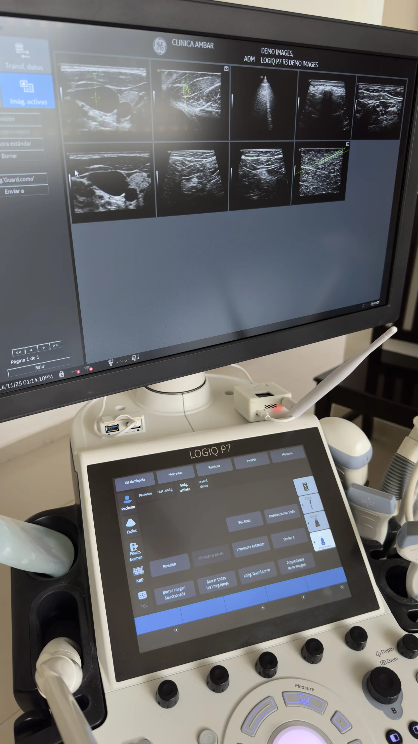 iTransfer connected beside a Versana ultrasound control panel